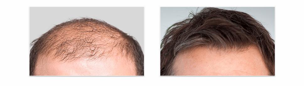 Hair ReVital X Hair Regrowth Formula Results